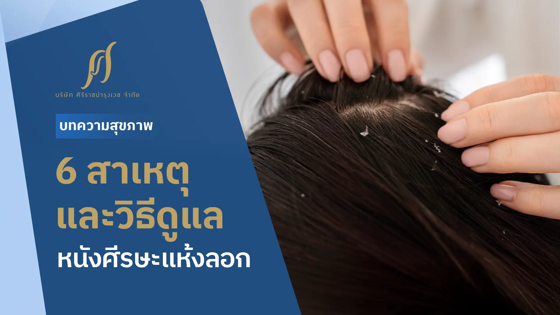ศีรษะที่เห็นผมสีดำมีรังแคและมัน และ Text “6 สาเหตุและวิธีดูแลหนังศีรษะแห้งลอก”