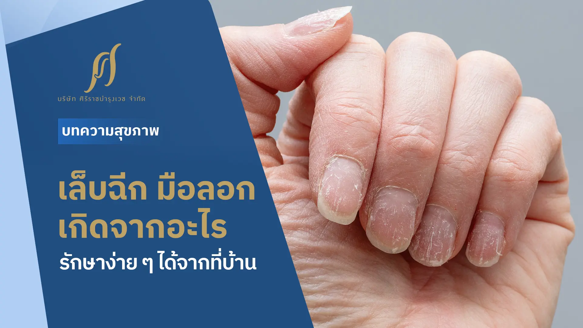 มือแห้งลอกและหน้าเล็บแห้งเป็นขุย Text ด้านข้าง “เล็บฉีก มือลอก เกิดจากอะไร รักษาง่าย ๆ ได้ที่บ้าน”