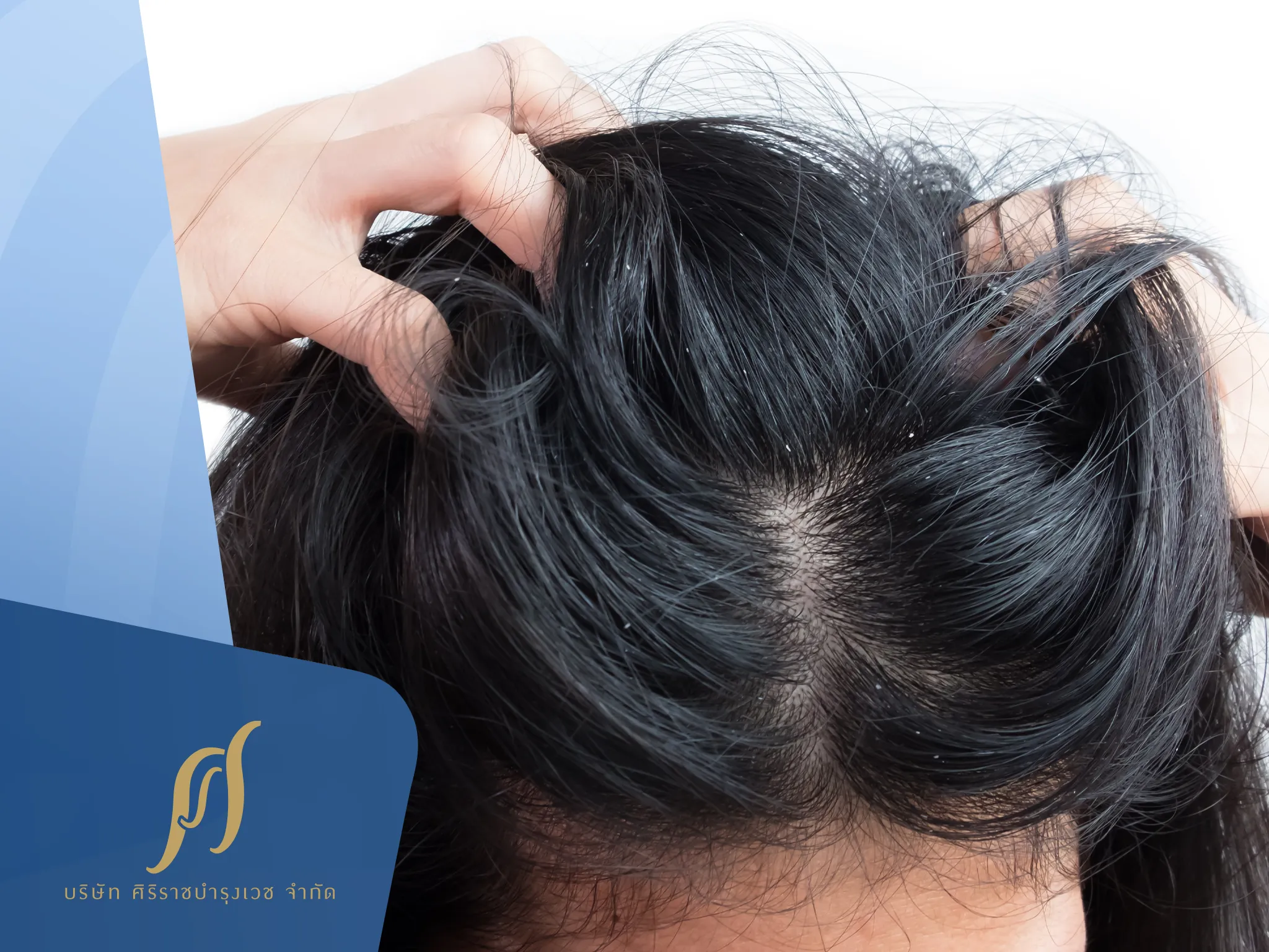 4 วิธีสระผมไม่ให้มีรังแค ทำง่ายได้ที่บ้าน เพื่อหนังศีรษะสะอาดและแข็งแรง